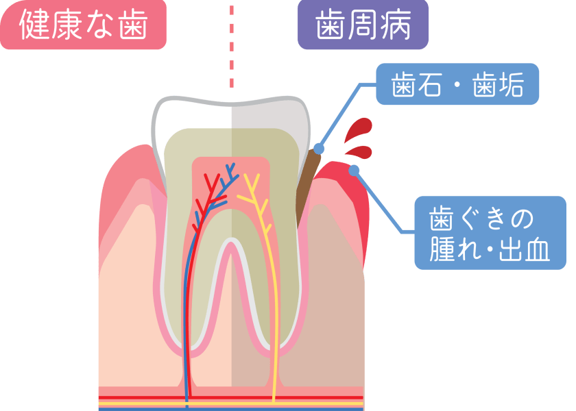 歯周病